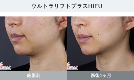 HIFU 症例写真1