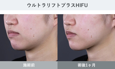 HIFU 症例写真2