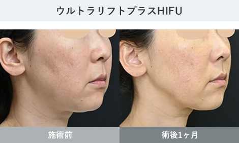 HIFU 症例写真3
