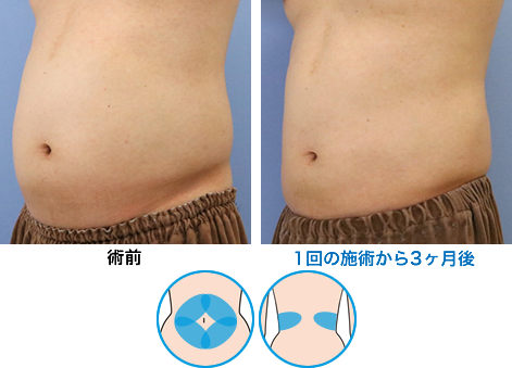 症例写真13 土屋さん(腹部4＋腰2エリア）1回の施術から3ヶ月後