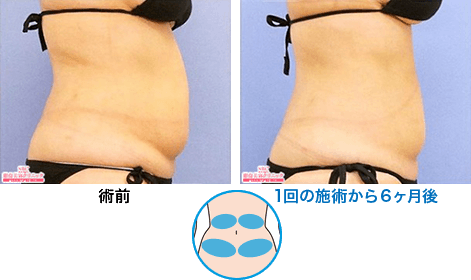 症例写真10 腹部 1回の施術から6ヶ月後 n198943